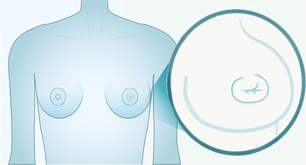 change in the appearance of one of both nipples (retraction inverted nipple)